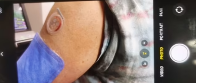 İnovatif Yöntemle Ağrısız ve Hızlı Ölçüm