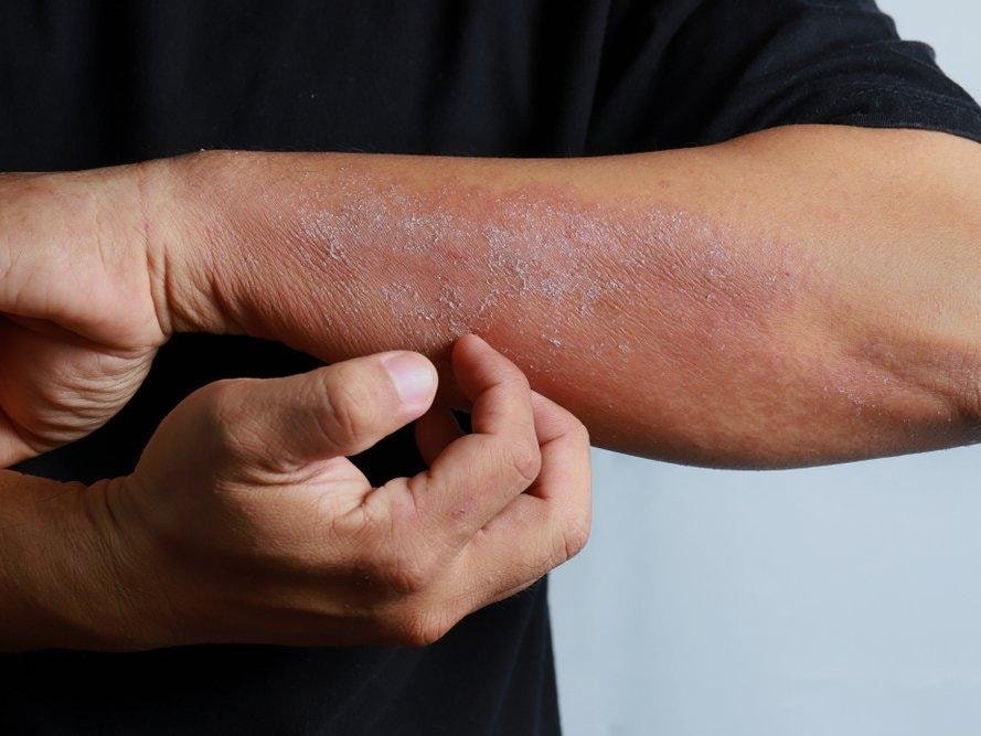Mantar Enfeksiyonları ve Antimikrobiyal Direnç: Sessiz Bir Pandemi