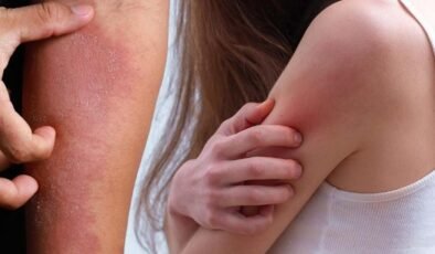 Uyuz Vaka Artışına Dikkat: Dermatoloji Uzmanı Doç. Dr. Erkin Pekmezci’den Önemli Uyarılar