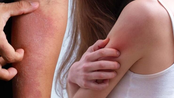 Uyuz Vaka Artışına Dikkat: Dermatoloji Uzmanı Doç. Dr. Erkin Pekmezci’den Önemli Uyarılar