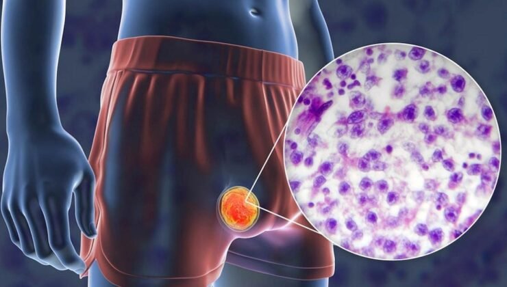 Prostat ve Testis Kanseri Farkındalığı Artıyor