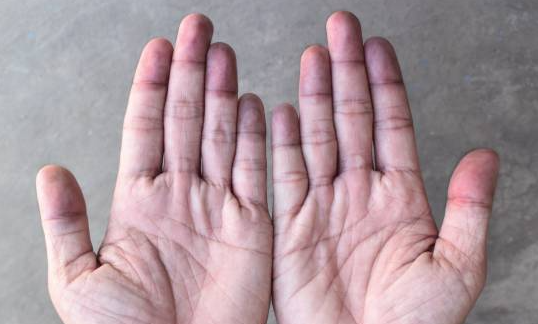 Çukurlu veya Tırtıklı Tırnak