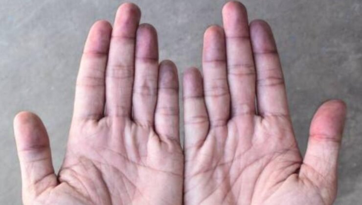 Tırnak Sağlığı: Kırılganlık ve Belirtilerin Anlamı