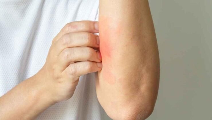 Kaşınmanın Vücut Üzerindeki Etkileri ve Sağlık Üzerindeki Rolü