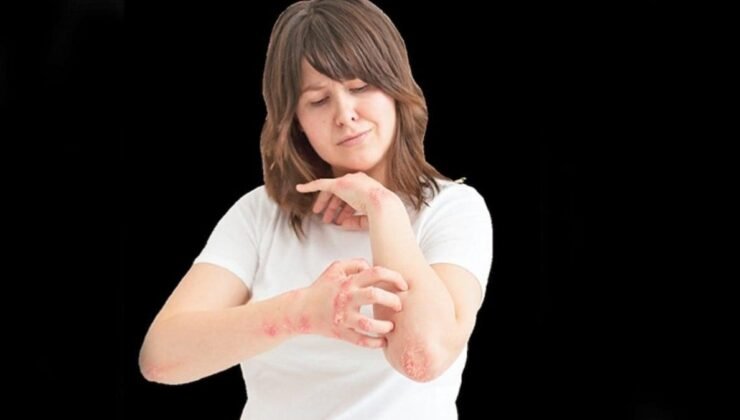 Zona Hastalığı: Belirtileri, Bulaşıcılığı ve Tedavi Yöntemleri