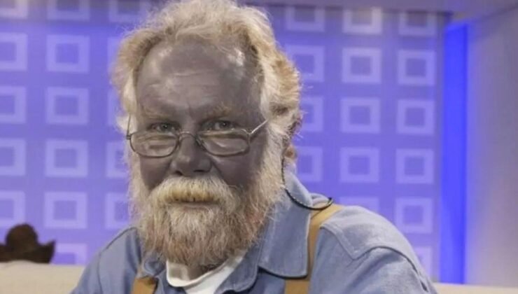 Argyria: Gümüşün Tehlikeleri ve Şirin Baba’nın Hikayesi