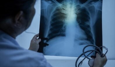 Akciğer Kanseri ve Beslenme İlişkisi