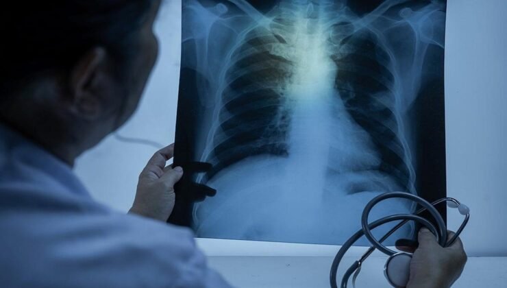 Akciğer Kanseri ve Beslenme İlişkisi