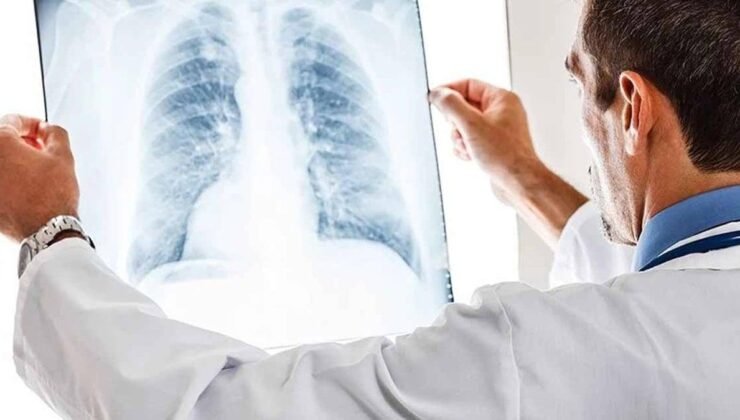 Akciğer Kanseri ve Çomak Parmak Belirtisi