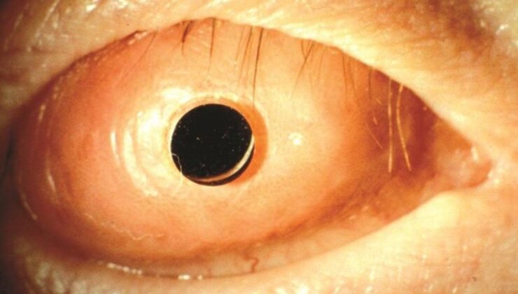 Kanada’da Devrim Niteliğinde Diş-Göz Ameliyatı: Osteo-Odonto Keratoprotez