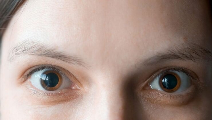 Norrie Hastalığı: Belirtileri, Genetik Yapısı ve Tedavi Yöntemleri