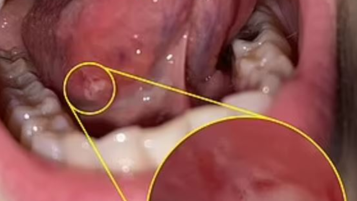 Basit Bir Ağız Ülseri Mi, Yoksa Kanser Mi?