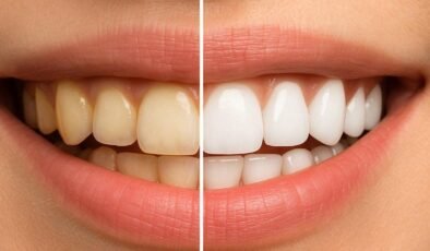 Vücudumuza Faydalı Gibi Görünen Bazı Yiyeceklerin Diş Sağlığımıza Zararları