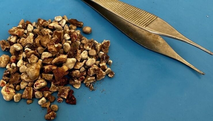 Böbrek Taşı Tedavisinde Yeni Bir Dönem: 300’den Fazla Taşla Dolmuş Böbrekler