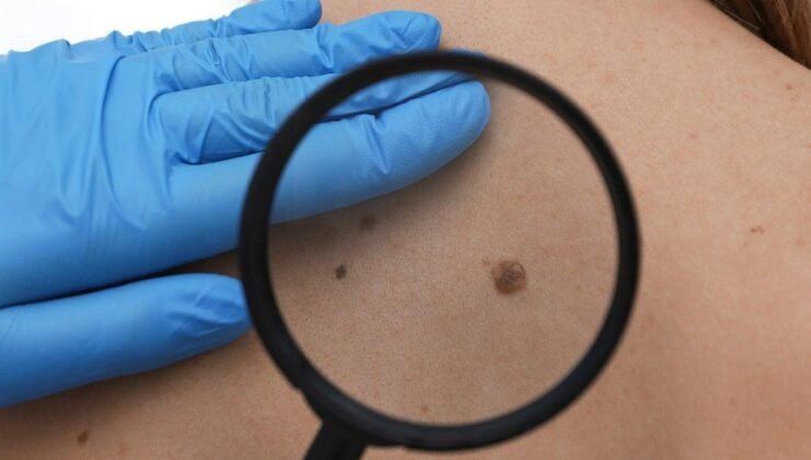 Cilt Kanseri Farkındalık Ayı: Riskler, Belirtiler ve Korunma Yolları