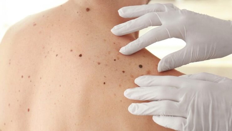 Cilt Kanseri ve Erken Tanı Yöntemleri