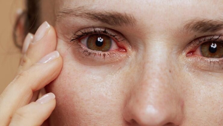 Göz Alerjisi Hakkında Kapsamlı Bilgi ve Uzman Tavsiyeleri