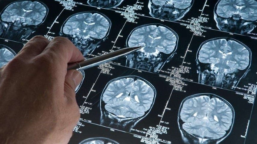 ABD’de Alzheimer Teşhisi İçin Yenilikçi Kan Testi