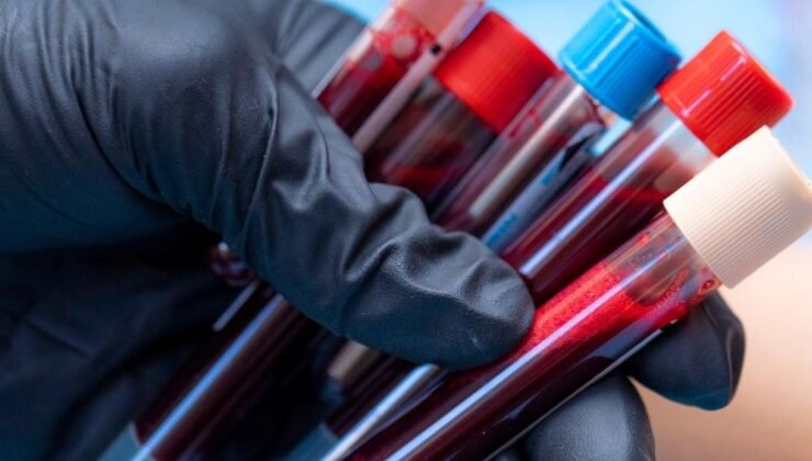 ABD’de Yeni Kan Testi ile Alzheimer Teşhisi Geliştirildi