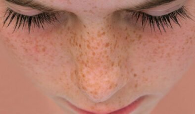 Cilt Lekeleri ve Tedavi Yöntemleri: Uzmanın Tavsiyeleri