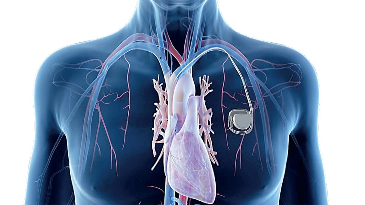 Kalp pili, stent, bypass: Hangisi ne zaman?
