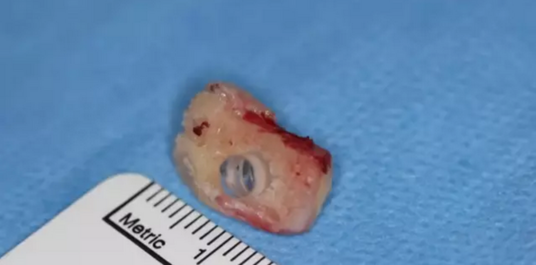 Göz Cerrahisinde Devrim: Diş Entegrasyonuyla Görmeye Bir Adım Yaklaşan Brent Chapman’un Hikayesi