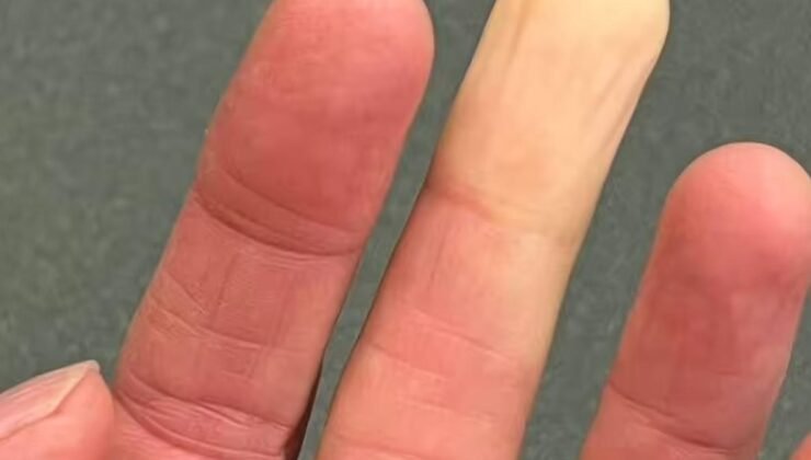 Raynaud Hastalığı: Soğukla Gelen Renk Değişimi ve Damar Sağlığı