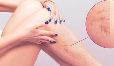 Varis: Erken Dönemde Anlaşılabilir Belirtiler ve Etkili Tedavi Yaklaşımları