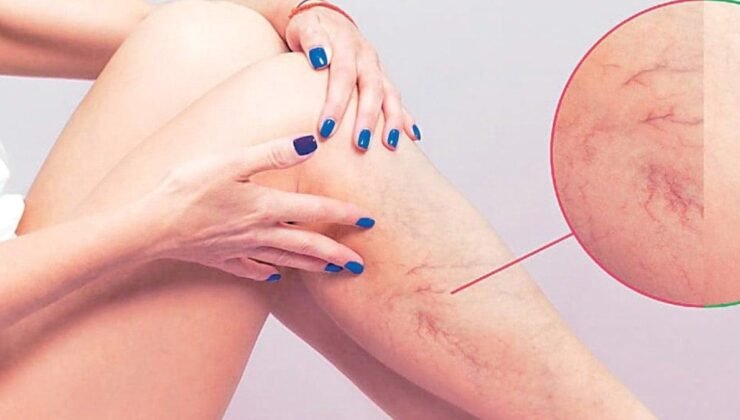 Varis: Erken Dönemde Anlaşılabilir Belirtiler ve Etkili Tedavi Yaklaşımları