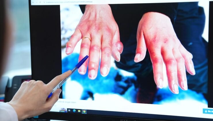 Soğuk Isırığına Karşı Bilinçli Korunma ve Tedavi Yaklaşımları