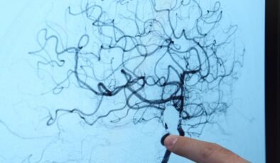 Beyin Anevrizması: Farkındalık ve Güncel Tanı/Tedavi Yaklaşımları