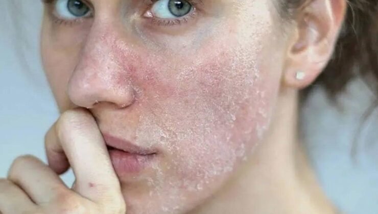 Kış Aylarında Cilt Bariyerini Güçlendirme Rehberi: Temizlikten Nemlendirmeye Uzman Tavsiyeleri