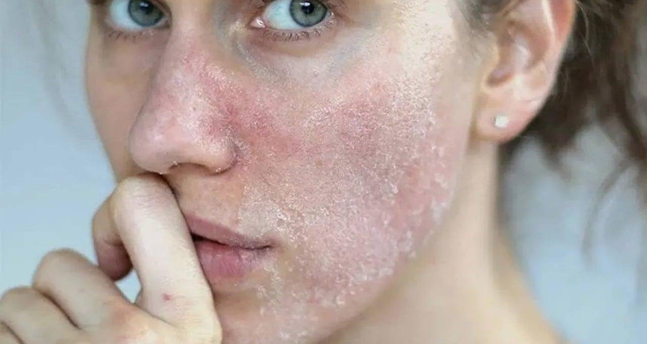 Kış Aylarında Cilt Bariyerini Güçlendirme Rehberi: Temizlikten Nemlendirmeye Uzman Tavsiyeleri