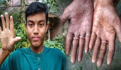 Parmak İzinden Bağımsız Yaşam: Adermatoglifiya ile Mücadele ve Biyometrik Zorluklar