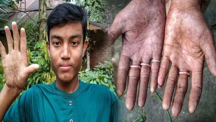 Parmak İzinden Bağımsız Yaşam: Adermatoglifiya ile Mücadele ve Biyometrik Zorluklar