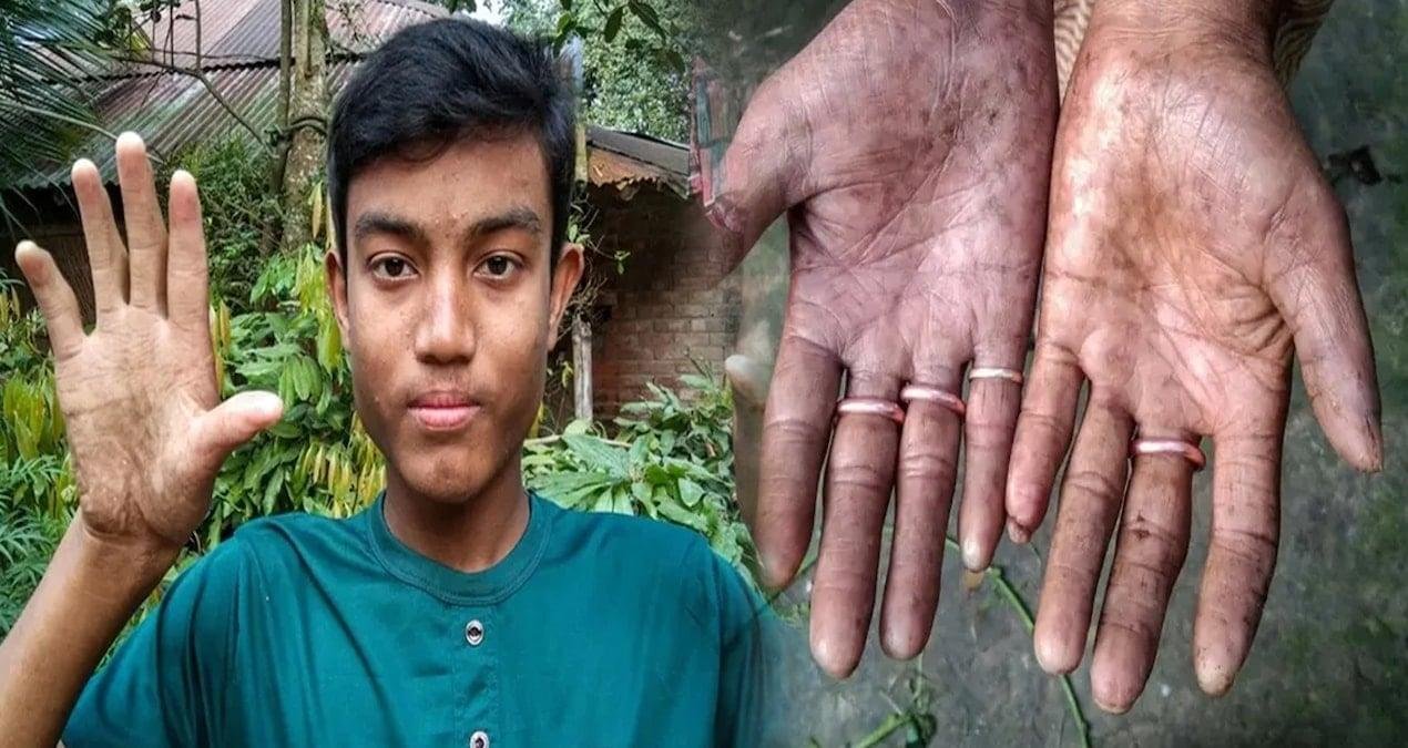 Parmak İzinden Bağımsız Yaşam: Adermatoglifiya ile Mücadele ve Biyometrik Zorluklar