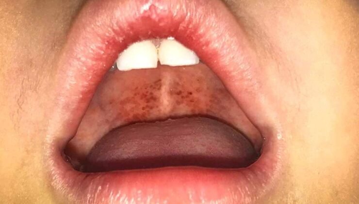 Ostrava’daki Difteri Vakaları: Aşıların Yaşlı Nesiller İçin Önemi ve Acil Tedavi Gerekliliği