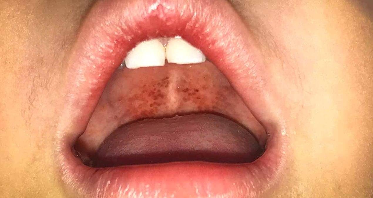 Ostrava’daki Difteri Vakaları: Aşıların Yaşlı Nesiller İçin Önemi ve Acil Tedavi Gerekliliği