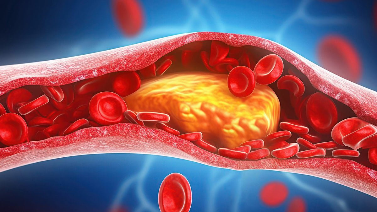 Karaciğer Yağlanması: Belirtiler, Nedenler ve Yaşanabilir Tedavi Yolları