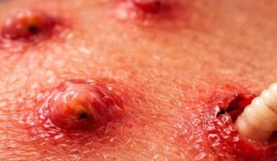 Perth’te 2015 Vakası: Uganda’da Yırtıcı Parazitlerin Kumaştan Yolculuğu ve Seyahat Güvenliği